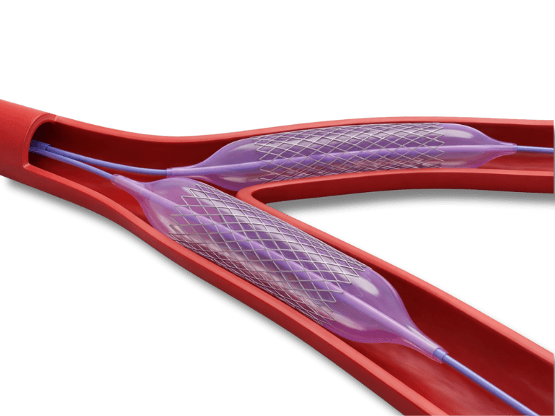Ilustração de angioplastia com stent em artéria